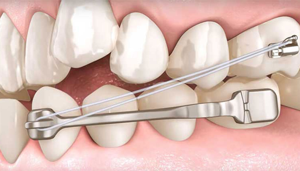 Carriere® Motion Appliance Orthodontic Treatment