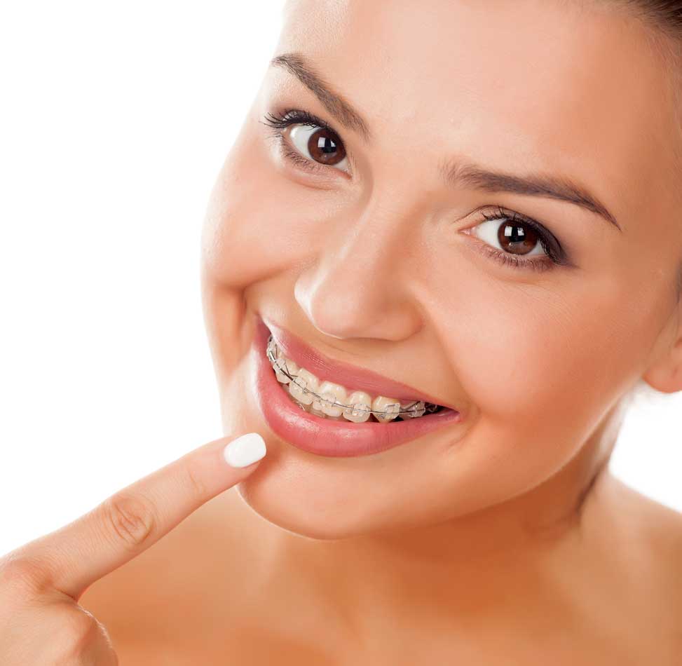 Ceramic Braces: What are They? A Discreet Orthodontic Solution at